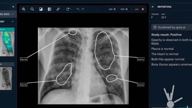 Ateneo Study: AI-Assisted TB Chest X-ray Screening Could Cut Costs to ₱877 Per Patient in Rural Health Units